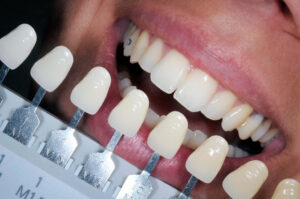 Teeth whitening in Stourbridge