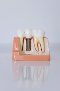 Dental implant model