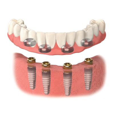 An implant retained denture