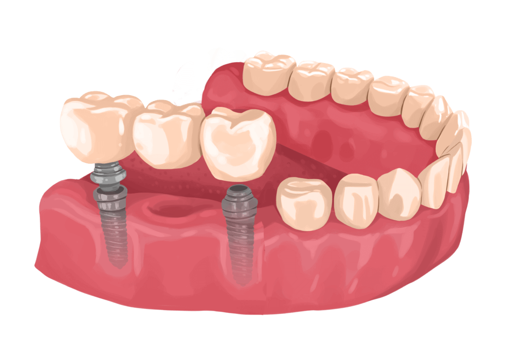 implant supported bridge in Stourbridge