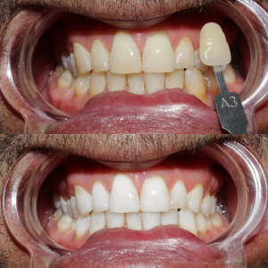 Teeth whitening before & after