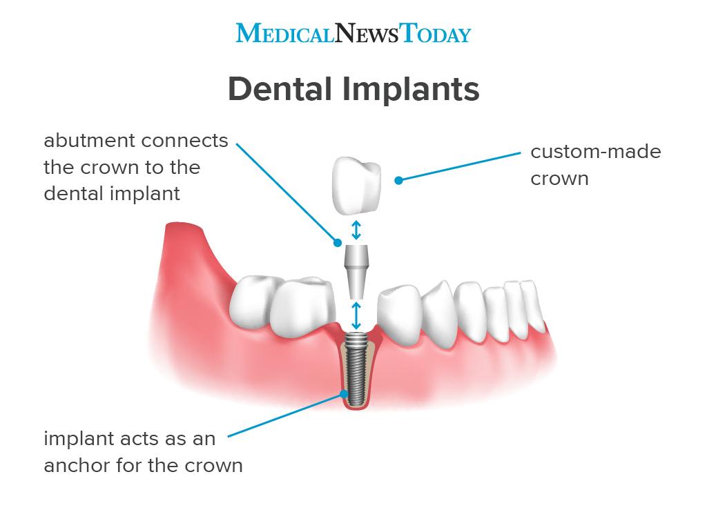 Labelled Diagram of Dental Implants