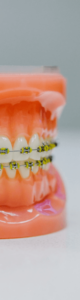Model of teeth with braces on