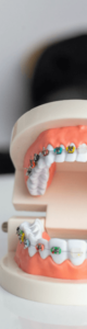 Model of teeth with braces on