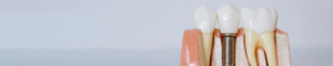 Model of Dental Implant
