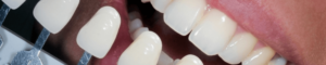 teeth compared to teeth whitening examples