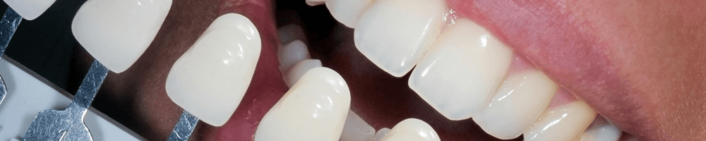 Teeth whitening graph in Stourbridge