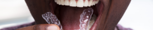 patient with invisalign