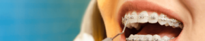 teeth with braces on