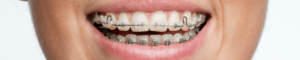 teeth with braces on