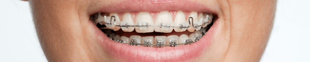 Adult metal braces in stourbridge smiling