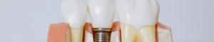 Model of Dental Implant