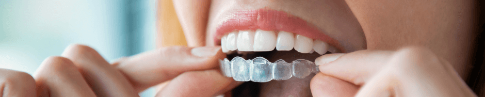 Woman in stourbridge inserting Invisalign clear braces into mouth