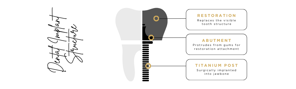 dental implant structure at Lion Dental Care in Stourbridge