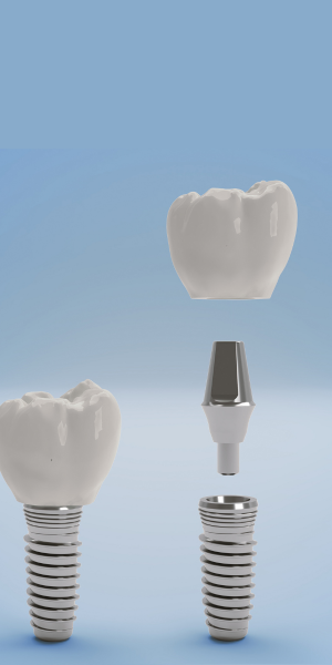 Dental Implant 