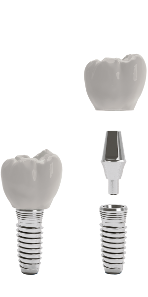 dental implant