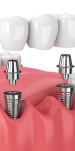 Dental Implant at Lion Dental