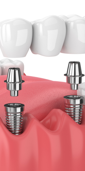 Dental Implants at Lion Dental