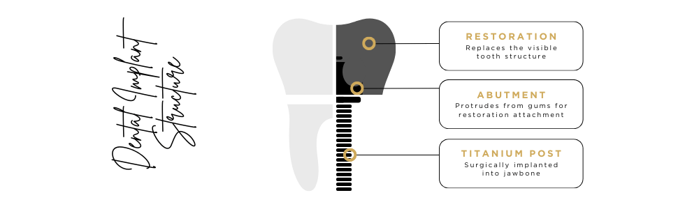 Dental Implant Display