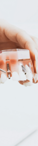 A Display of Dental Implants