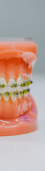 Fixed metal braces model in Stourbridge dentist